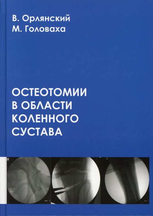 Остеотомии в области коленного сустава