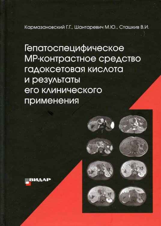 Гепатоспецифическое МР-контрастное средство &quot;гадоксетовая кислота&quot; и результаты его клинического применения