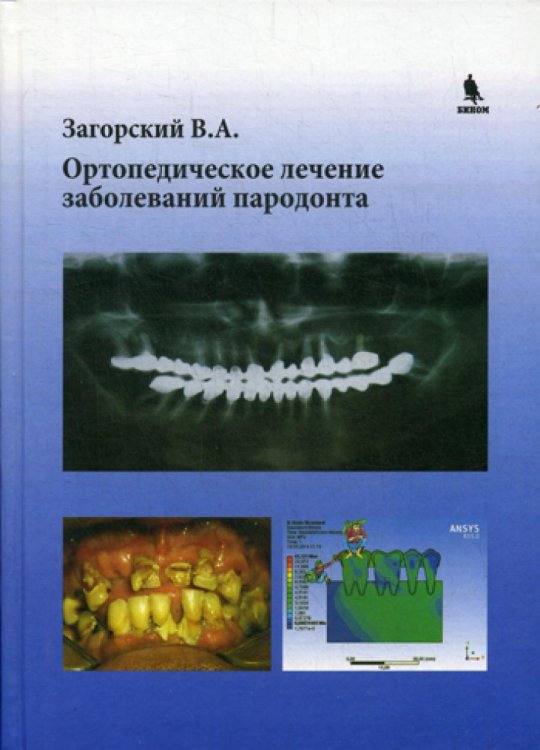 Ортопедическое лечение заболеваний пародонта